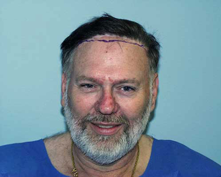 Before Image: Patient # 75625 - 