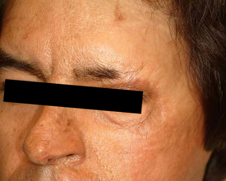 Before Image: Patient # 45680 - 