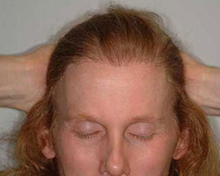 After Image: Patient # 54834 - 