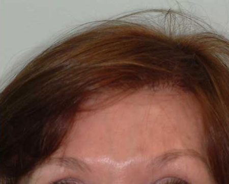 After Image: Patient # 39457 - 