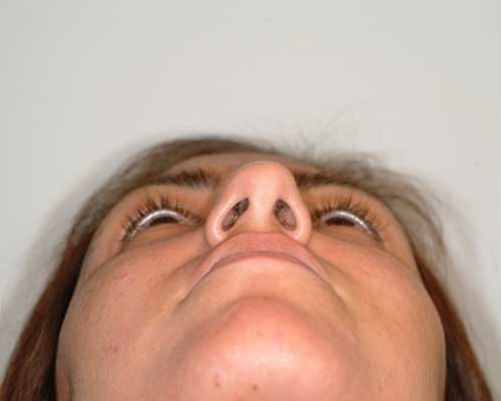 Before Image: Patient # 78856 - 