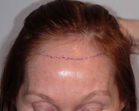 Before Image: Patient # 39457 - 