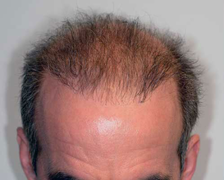 Before Image: Patient # 80916 - 