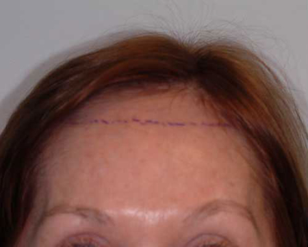 Before Image: Patient # 39457 - 