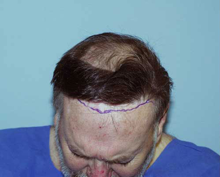 Before Image: Patient # 75625 - 