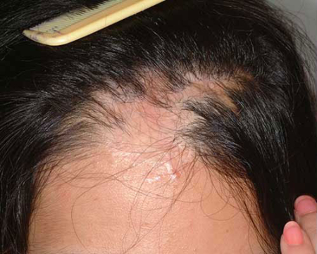 Before Image: Patient # 41635 - 