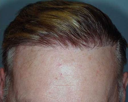 After Image: Patient # 75625 - 