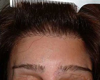 After Image: Patient # 79193 - front