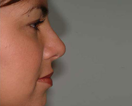 After Image: Patient # 78856 - 