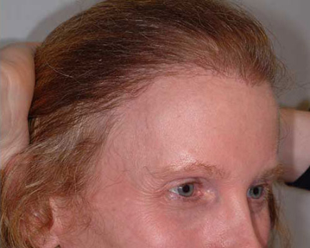 After Image: Patient # 54834 - 