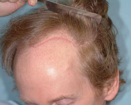 Before Image: Patient # 54834 - 
