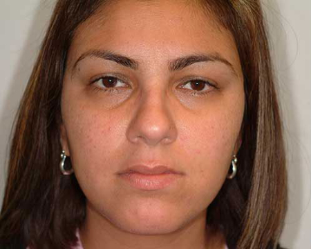Before Image: Patient # 78856 - 