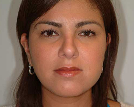 After Image: Patient # 78856 - 