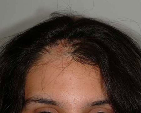 Before Image: Patient # 41635 - 