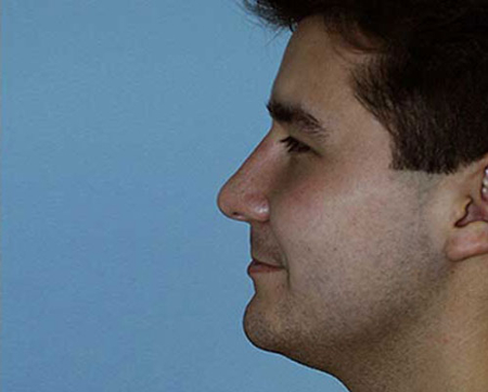 After Image: Patient # 17926 - 