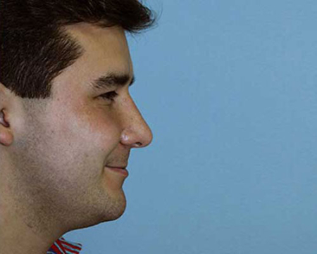 After Image: Patient # 17926 - 