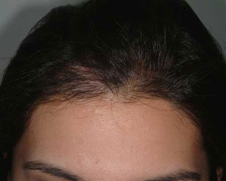 After Image: Patient # 41635 - 