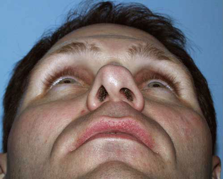 Before Image: Patient # 69195 - 