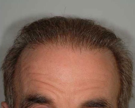 After Image: Patient # 80916 - 