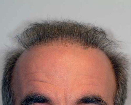 Before Image: Patient # 80916 - 