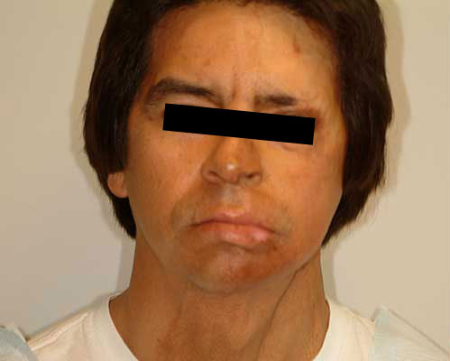 Before Image: Patient # 45680 - 