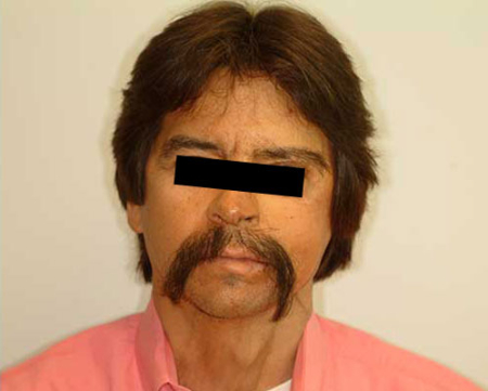 After Image: Patient # 45680 - 