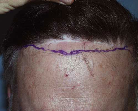 Before Image: Patient # 75625 - 