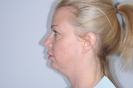 Before Image: Patient # 98845 - 