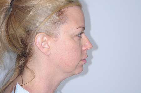 Before Image: Patient # 98845 - 