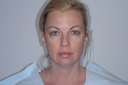 Before Image: Patient # 98845 - 