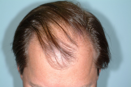 Before Image: Patient # 33228 - 
