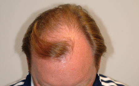 Before Image: Patient # 17156 - 