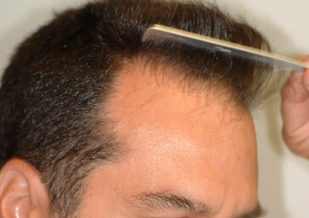 Before Image: Patient # 99952 - 