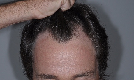 Before Image: Patient # 50904 - 