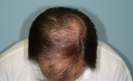 Before Image: Patient # 33228 - 