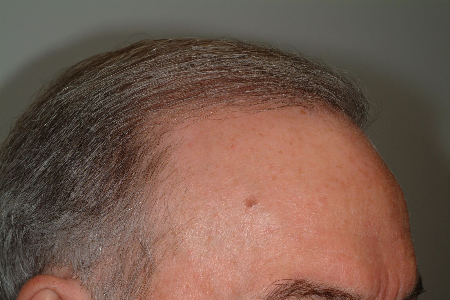 After Image: Patient # 61157 - 