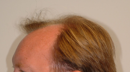 Before Image: Patient # 17156 - 