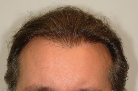 After Image: Patient # 29198 - 