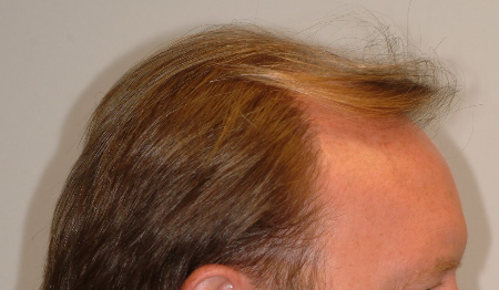 Before Image: Patient # 17156 - 