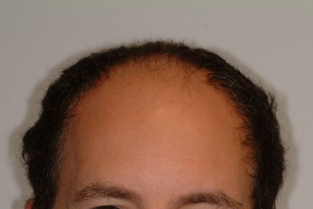 Before Image: Patient # 48126 - 