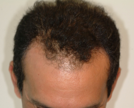 Before Image: Patient # 86050 - 
