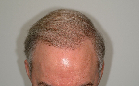 After Image: Patient # 61157 - 