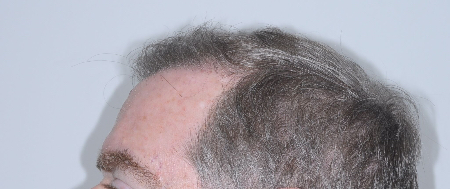 After Image: Patient # 93615 - 