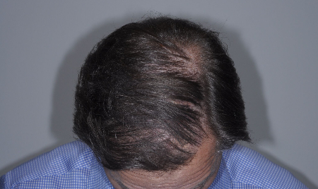 After Image: Patient # 33228 - 