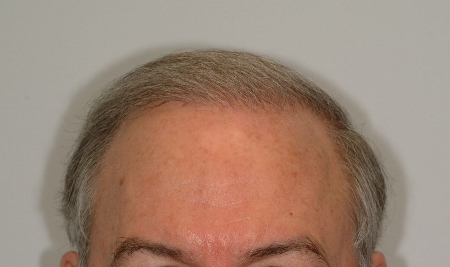 After Image: Patient # 61157 - 