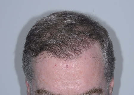 After Image: Patient # 93615 - 