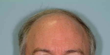 Before Image: Patient # 61157 - 