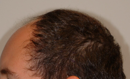 Before Image: Patient # 48126 - 