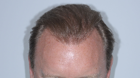 After Image: Patient # 17156 - 
