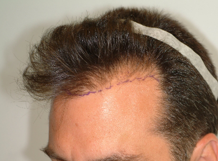 Before Image: Patient # 99952 - 